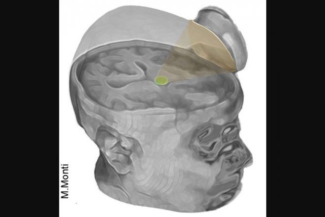 Еще двух пациентов удалось вывести из комы при помощи ультразвука 
