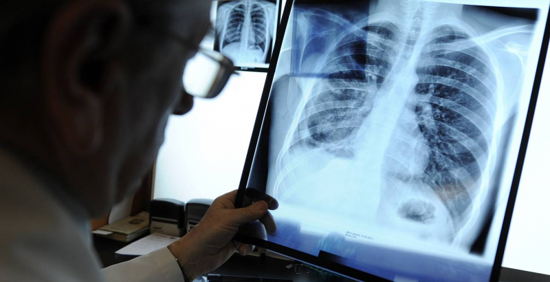 Препараты от туберкулеза перестают действовать. Что делать с лекарственной устойчивостью?