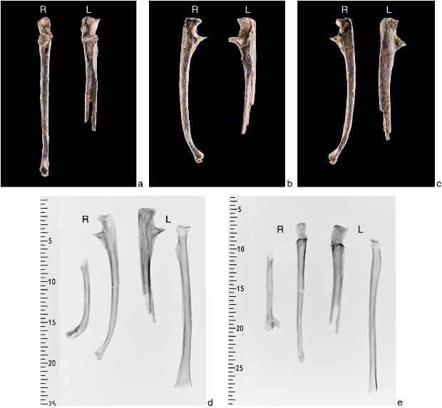 Палеопатологи обнаружили самый тяжелый случай деформации Маделунга на древних останках