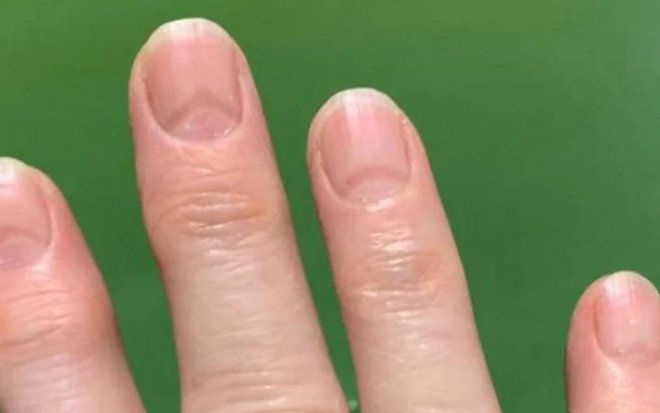 Выявлен новый индикатор заражения COVID-19: «ковидные ногти»