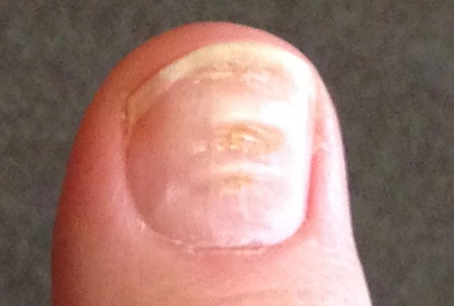 Выявлен новый индикатор заражения COVID-19: «ковидные ногти»