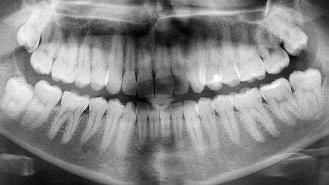 Пептидная паста поможет устранить повреждения эмали зубов без всякого лечения