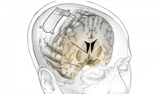 Экспериментальный мозговой имплант мгновенно избавит от неизлечимой депрессии