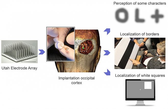 Имплант в головном мозгу подарил слепой женщине искусственное зрение