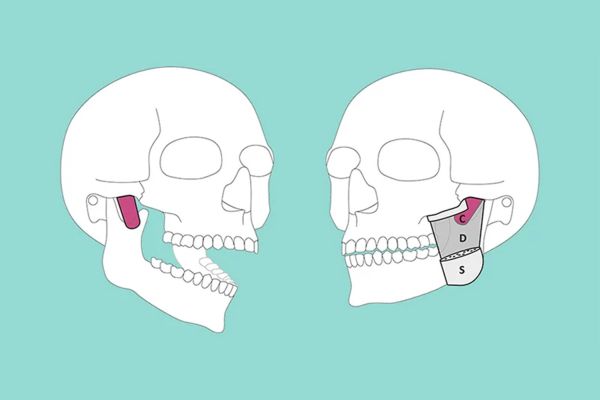 Ученые открыли в человеческой челюсти новую мыщцу