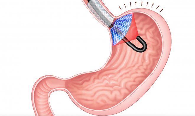 Лазерный имплант в желудке поможет бороться с ожирением