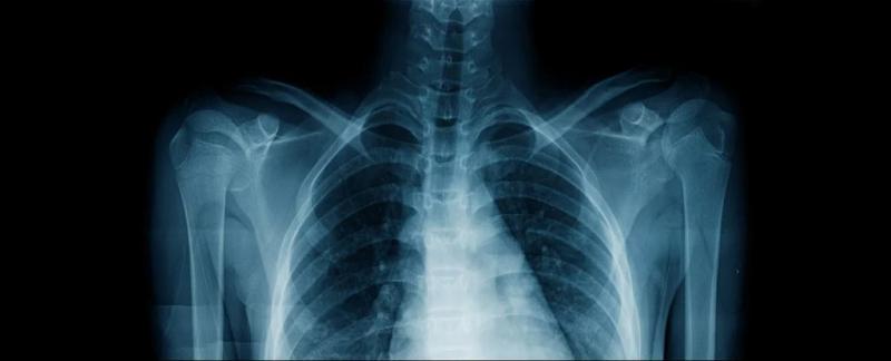 ИИ может предсказывать расу людей по рентгеновским снимкам, и ученые обеспокоены