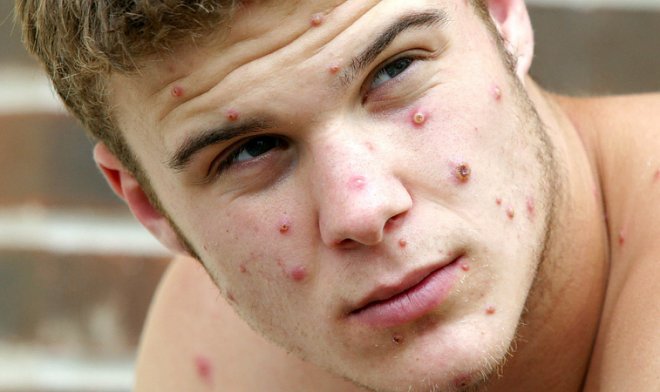 Почему текущей вспышки обезьяньей оспы не следует бояться