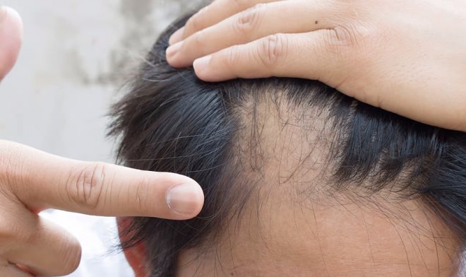 В США официально одобрили первое в своем роде лекарство от облысения