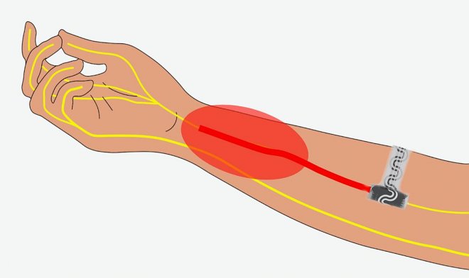 Растворимый имплантат устранит боль через охлаждение нервов