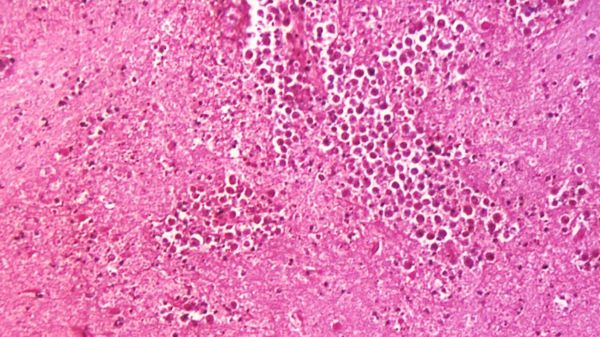 Амеба, поедающая мозг: как уберечься от смертоносной инфекции?