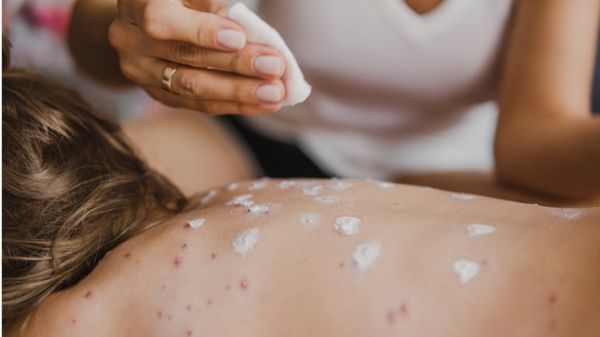 В России вспышка заболеваемости корью. Так бывает каждые несколько лет