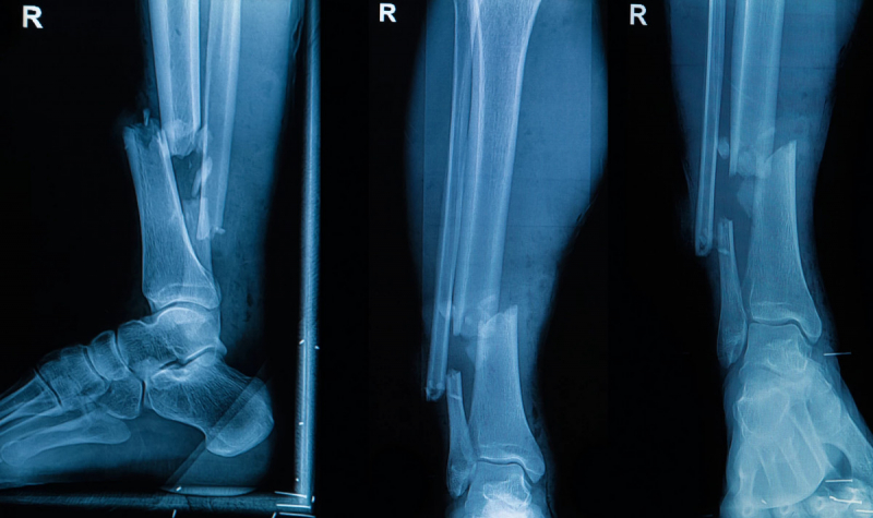 Клеевой пистолет позволит печатать заплатки для сломанных костей прямо во время операции