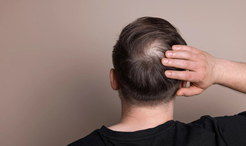 В США завершаются испытания первой эффективной таблетки от облысения