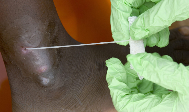 Человечество в шаге от полной победы над второй (после оспы) инфекционной болезнью в истории