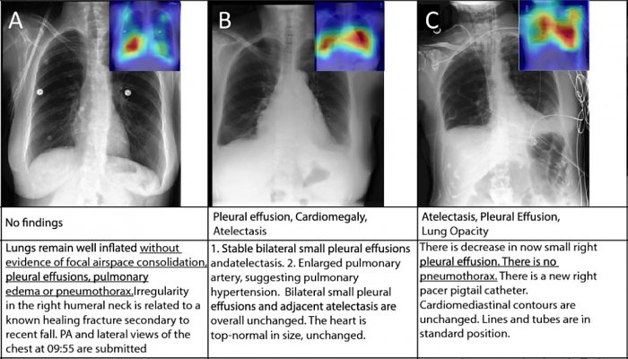 В «Сколтехе» обучили нейросеть обрабатывать рентген-снимки легких и ставить диагноз